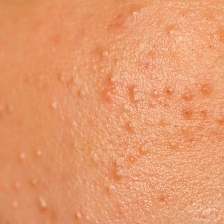 Acne Skin