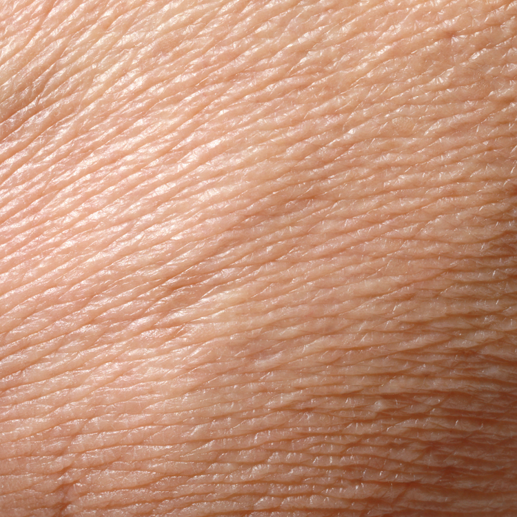 Dehydrated Skin