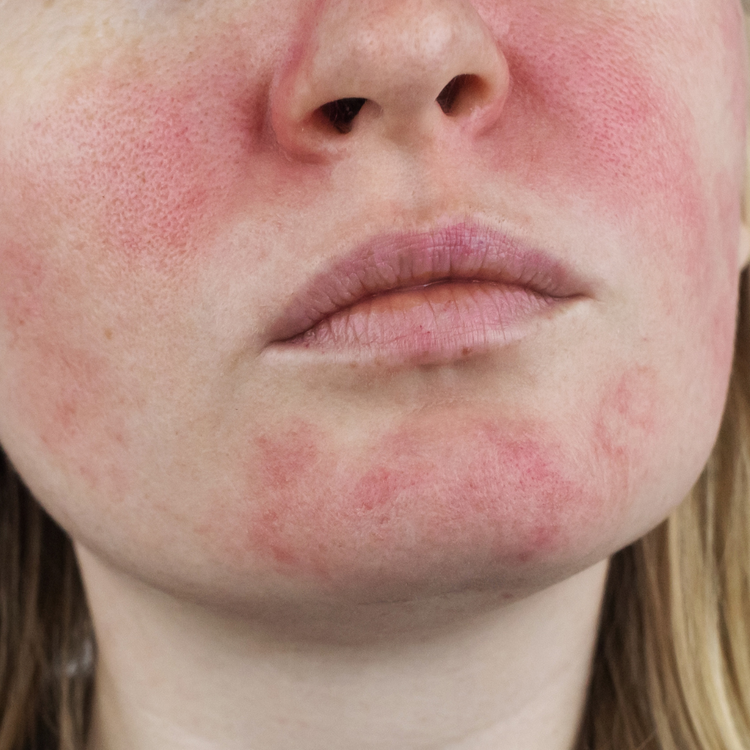 Rosacea Skin