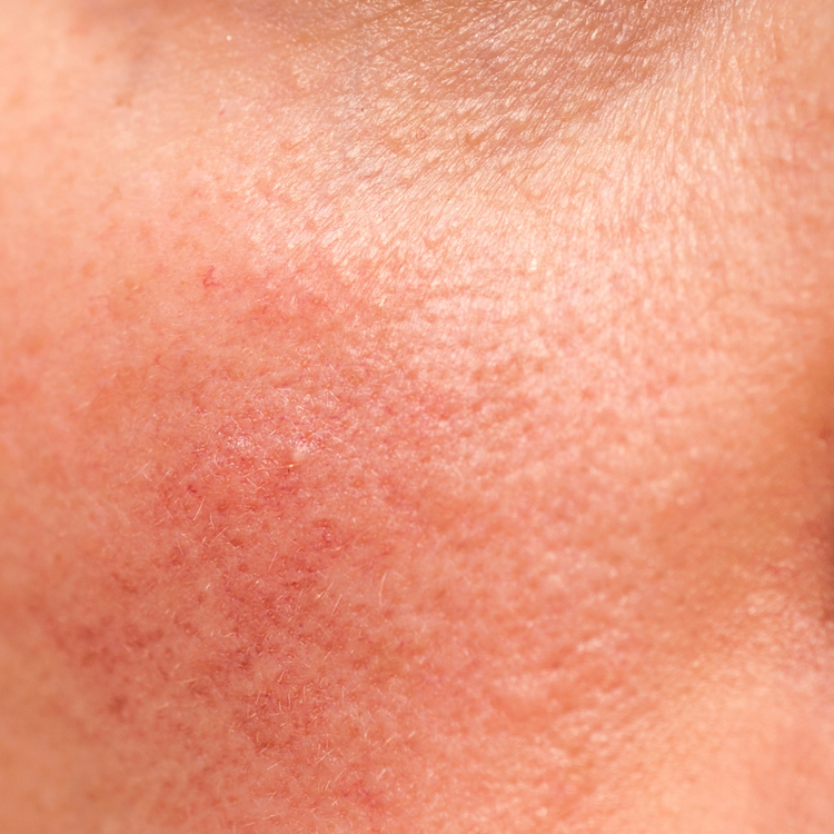 Sensitive Skin